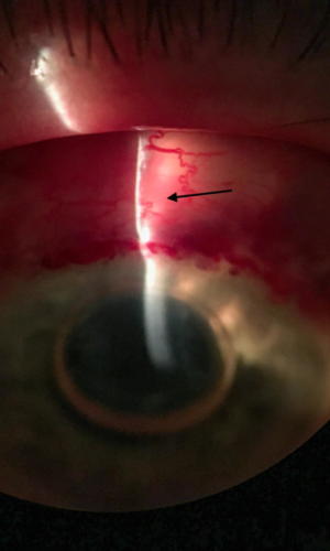 Glaucoma surgery - filtering bleb